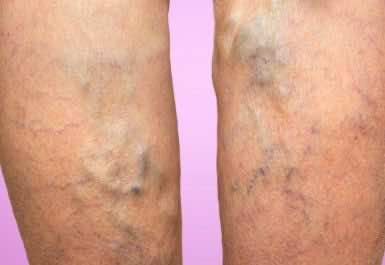 What is Varicose veins?